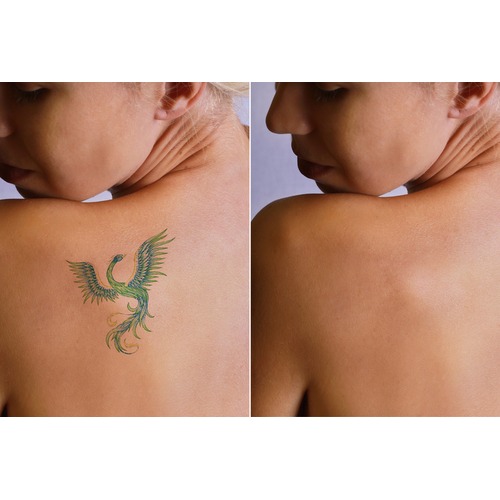 Tattoo Removal