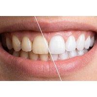 Professional Teeth Whitening Session, Farnworth