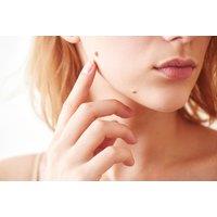 Mole, Skin Tag or Wart Removal - 1 or 2 Removals at MPM Medicals, Sutton Coldfield, Birmingham