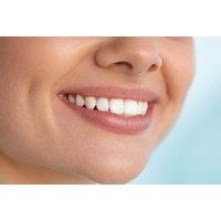 Laser Diamond Teeth Whitening - One-Hour Naturawhite Treatment At Peridot Aesthetics, On-Site In Solihull