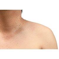 1 Session Skin Tag Removal at REM Laser Clinic - Bolton
