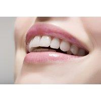 Dental Consultation & Custom Home Teeth Whitening Kit With Three Gel Syringes At Wilton Dental Practice, On-Site In London Victoria