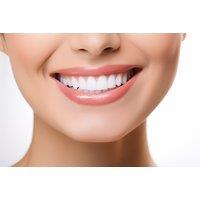 Laser Teeth Whitening Treatment With Megawhite Technology At Best Laser Room, Chelsea - 30-Minute In-Clinic Session