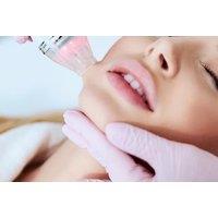 Skin Rejuvenation Microneedling Treatment with Michele Osmak Aesthetics - Cardiff
