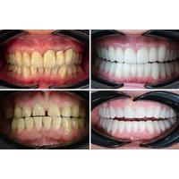 Full Smile Makeover Including 20 Zirconia Crowns: 7-Night Half Board Stay & Airport Transfers - Healing Journey Medical, Antalya Turkey!