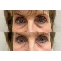 Polynucleotides Treatment - AesthetiSKN - Stoke-On-Trent