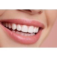 Award Winning Composite Bonding for 2, 4, or 8 Teeth - With Consultation - Wembley Orthodontic & Aesthetics Clinic