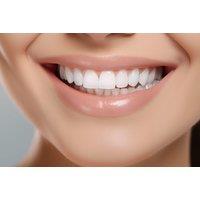 Composite Bonding 2,4, 6 or 8 Teeth - Icedent Dental - London