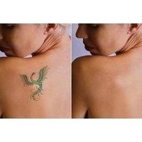 Professional Laser Tattoo Removal Session on a Choice of Area - Inspiration Beauty, London