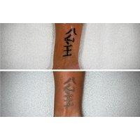 Up to 3 Sessions of Laser Tattoo Removal - Small or Medium - Laser You, Bury