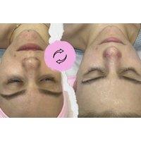 Luxury Glow Hydrafacial Treatment - Adiva's Clinic, Windsor