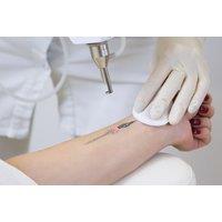 Laser Tattoo Removal Session from Choice of Area - 5 Options - Aesthetics by Taylor Eaves, Walsall