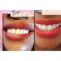 Professional Salon Teeth Whitening Treatment - Aesthetics by Faith, Brentwood