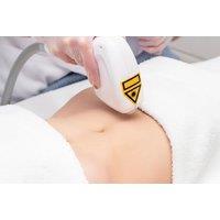 Six Diode Ice Laser Hair Removal Sessions