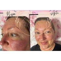 Bespoke Deep Cleansing Facial - Aesthetics by Faith, Brentwood