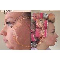 Lemon Bottle Fat Dissolving Treatment - Aesthetics by Faith, Brentwood
