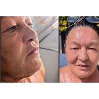 Radio Frequency (RF) Facial - Aesthetics by Faith, Brentwood