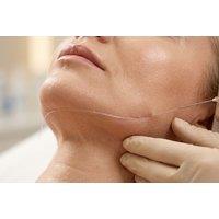 PDO Thread Lift for Face Areas and Instant Skin Tightening in London