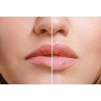 1ml Lip Filler or Laugh Line Filler for Softer, Natural-Looking Skin