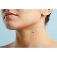Professional Skin Tag Removal Treatment - Milton Keynes